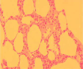 ОТСУТСТВИЕ ПАТОЛОГИЧЕСКИХ ИЗМЕНЕНИЙ И КАЛЬЦИФИКАТОВ ПРИ ВВЕДЕНИИ АЛЛОГЕННОГО ГАП